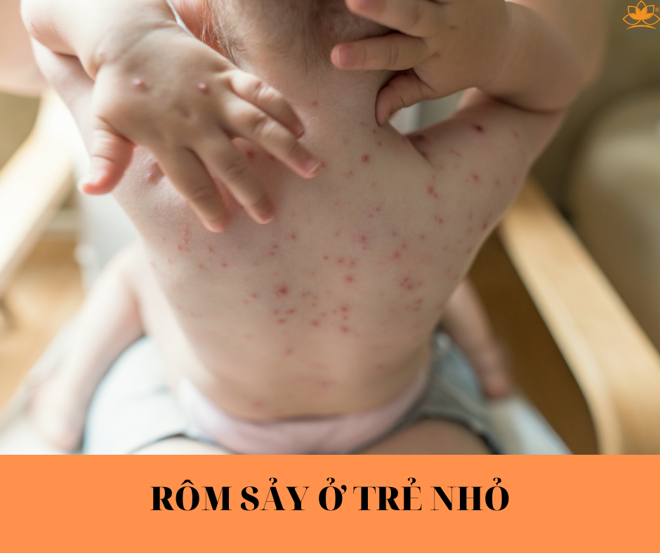 RÔM SẢY Ở TRẺ NHỎ
